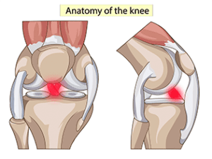 ACL Pain