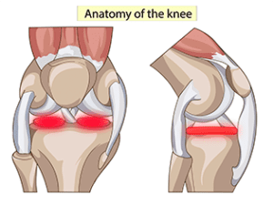 Meniscus Pain